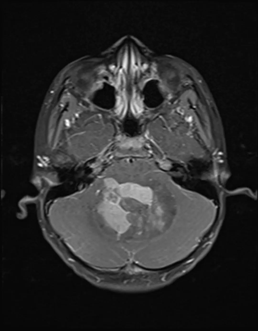 经典型髓母细胞瘤,影像诊断图片解析