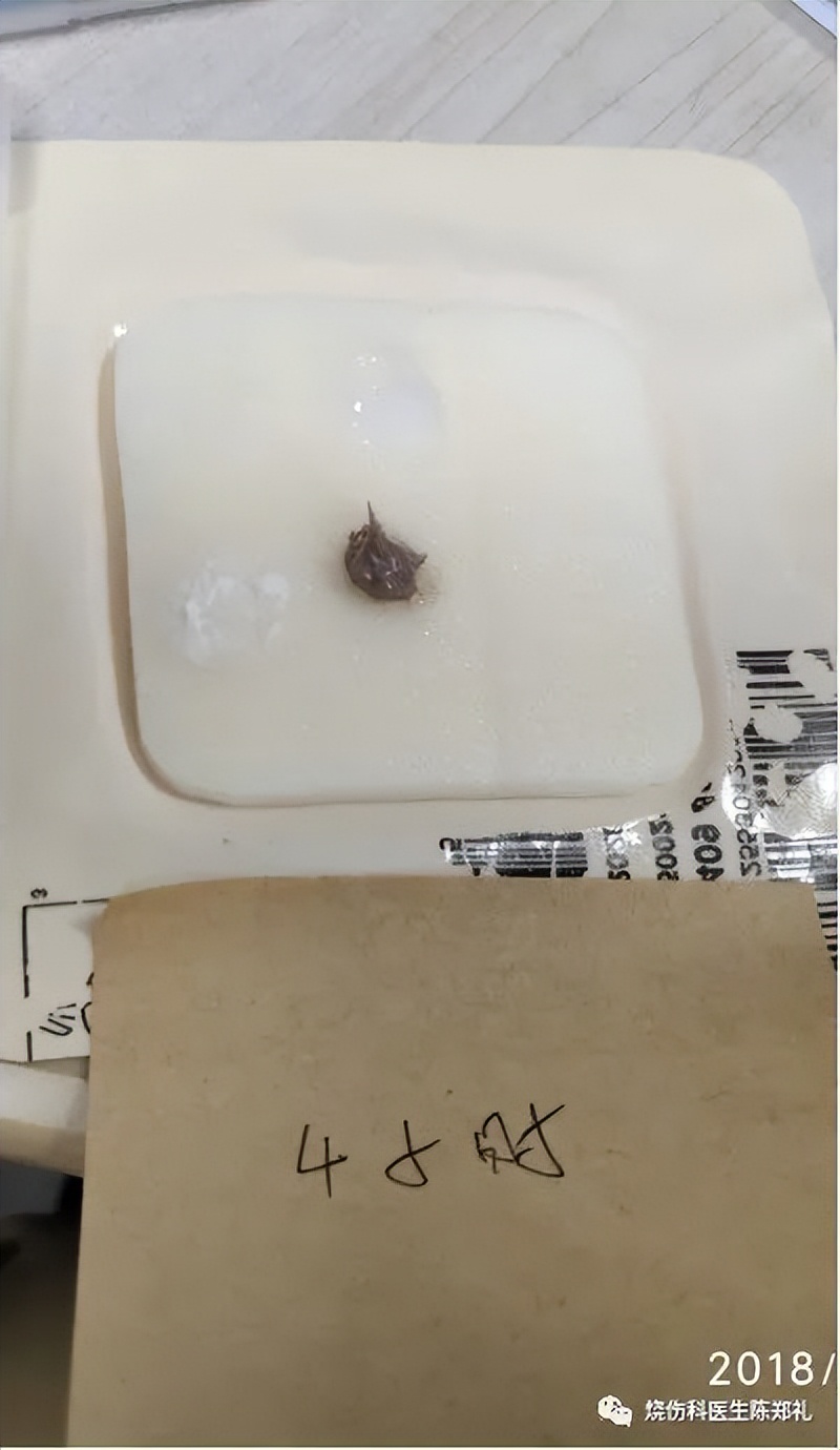 慢性创面患者的敷料运用及选择,创面换药敷料的选择