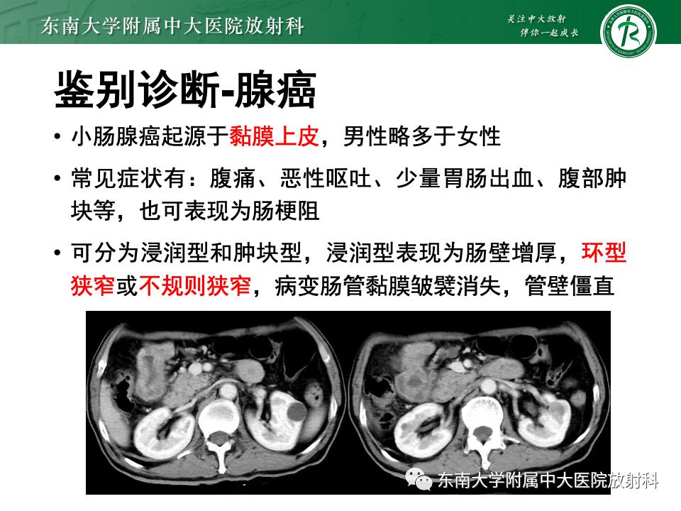 小肠间质瘤最新治疗中药方,小肠间质瘤基因检测