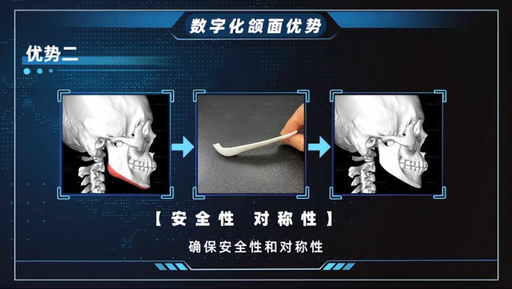 重庆华美整形美容医院假体下巴,重庆华美下颌角整形案例