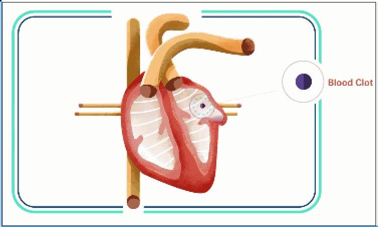 射频消融北医三院,省立三院房颤手术