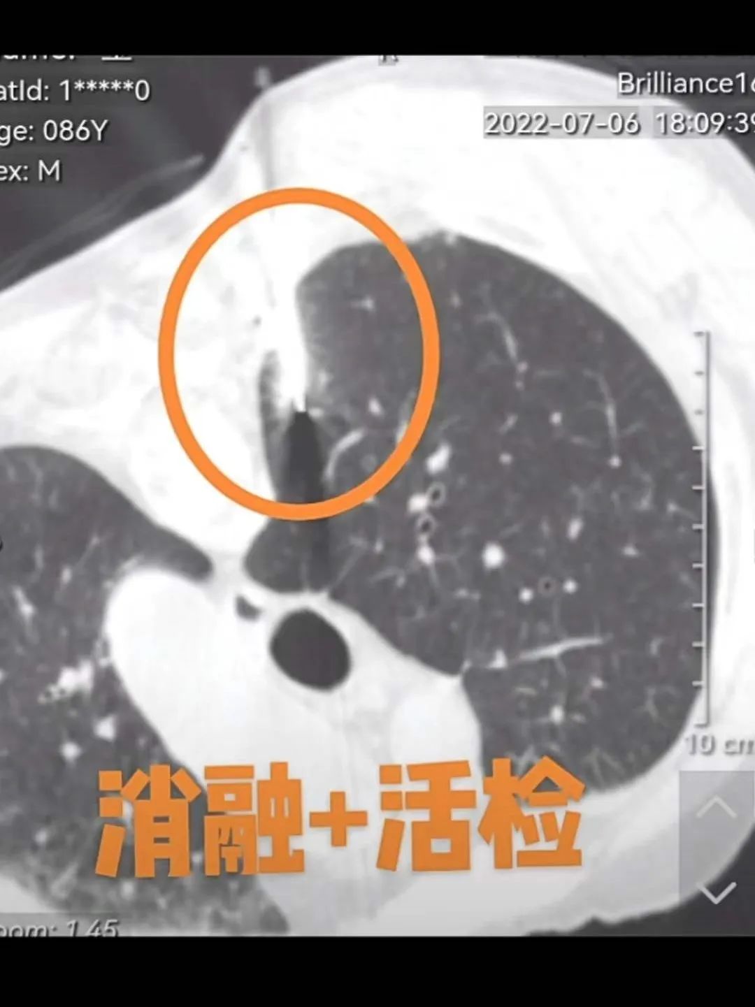 浙江首例！医生用钝头微波消融针为8旬老人“烫死”高危肺结节