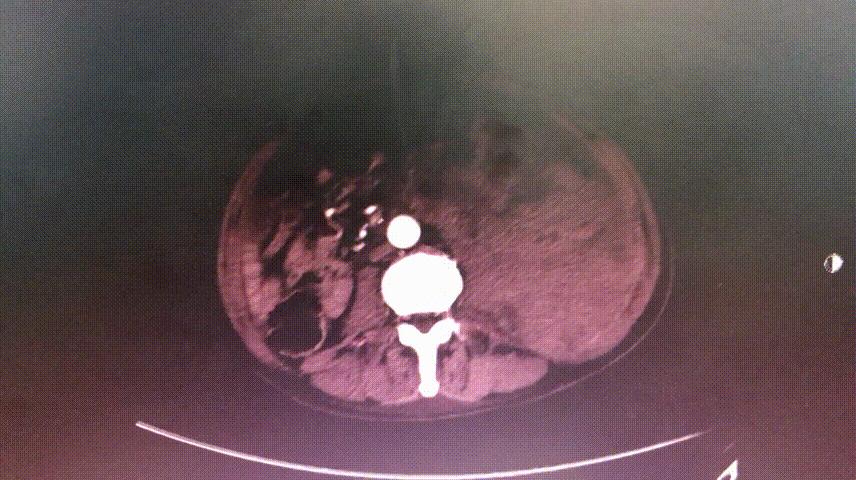 病例回顾与分享,腹膜后血肿介入治疗
