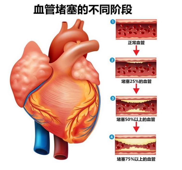 中药奇方三通汤，通心、脑、血管，通全身淤血，散于止痛