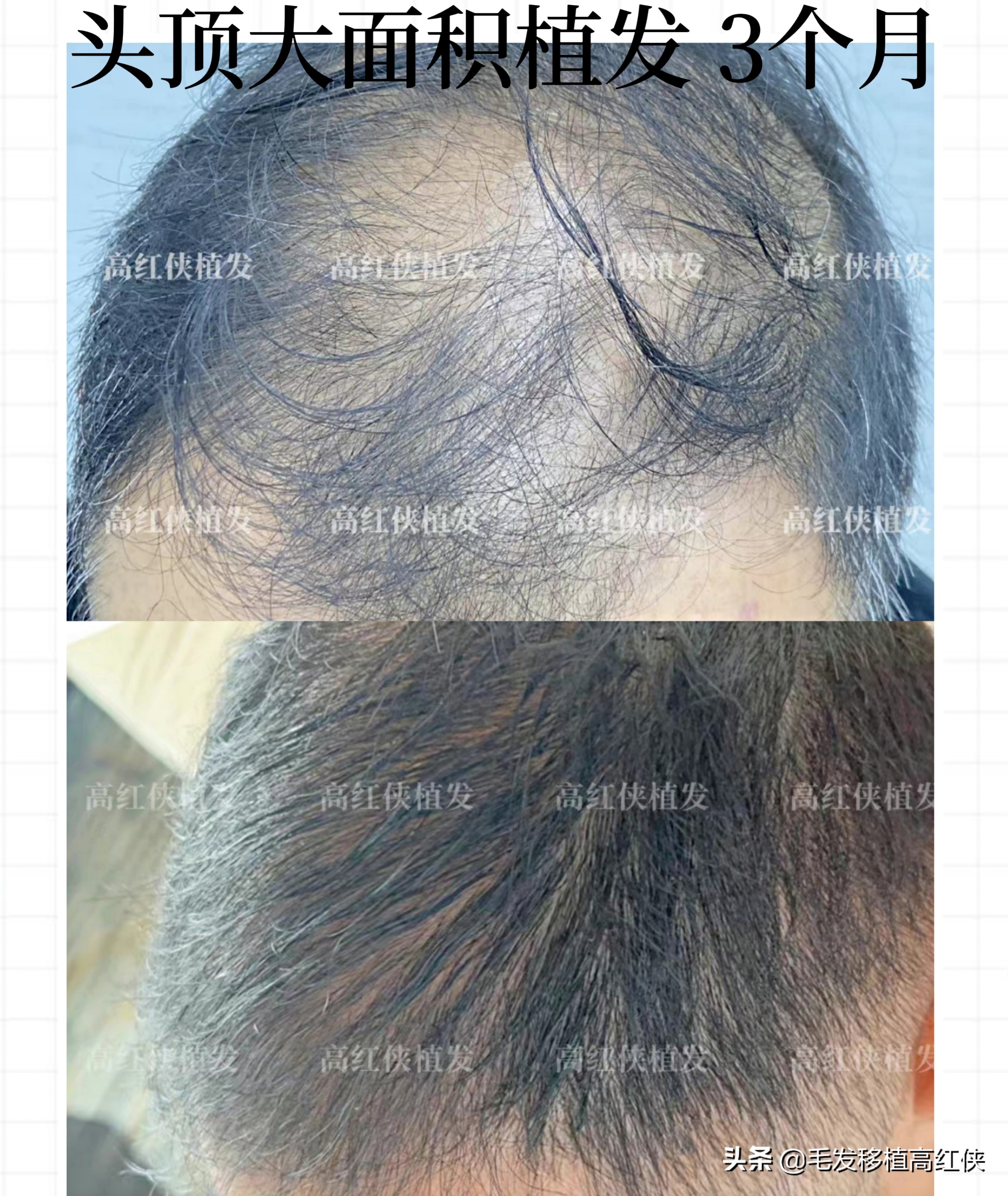 头顶秃了头发稀少怎么扎,头顶秃了头发稀少怎么剪发