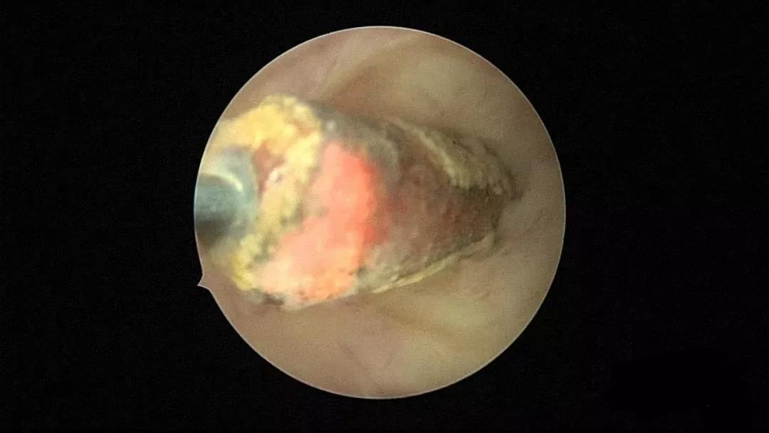 子宫里也会有脓？！这不是危言耸听，图文带你看懂