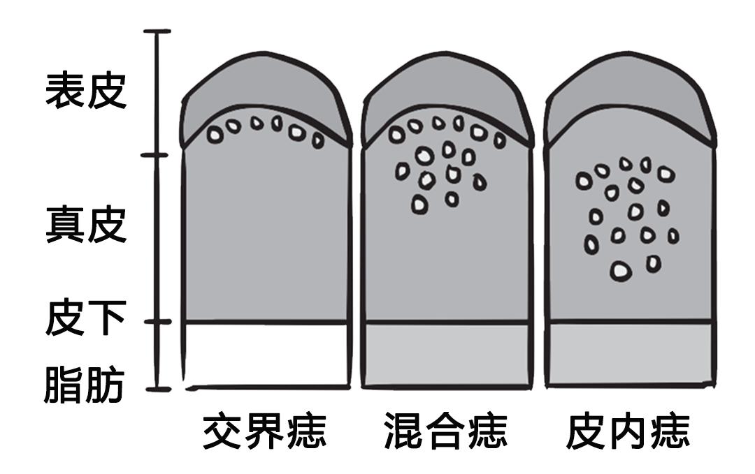 如何判断新长的痣是不是黑色素瘤,正常痣和黑色素痣图片对比说明