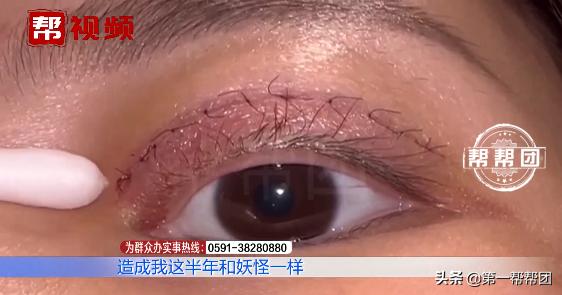 90后割双眼皮亲身经历,割了双眼皮后特后悔