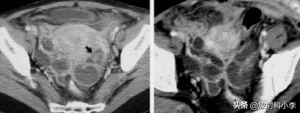 妇科急腹症的ct表现,妇科急腹症的诊断与治疗