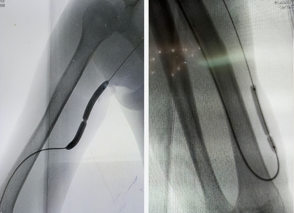 国产药物球囊什么时间上市的 (国产最早药物球囊上市时间)