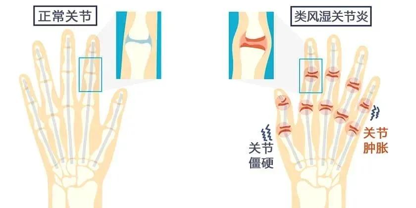 手指关节疼肿胀变形要警惕四种病,手指关节变形是风湿吗吃什么药