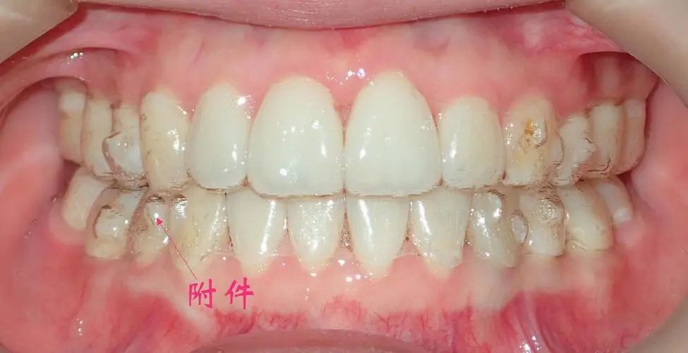 整牙亲身经历分享一下,整牙的经历分享