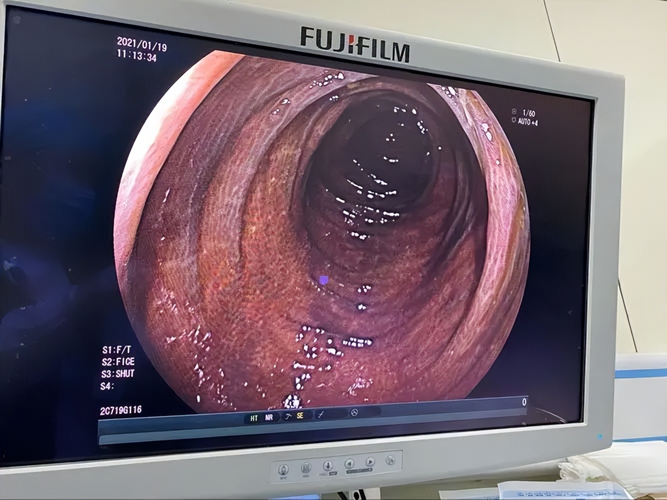 女子四处求医治便秘,结果走一大圈弯路,专家:我有一个更好方案