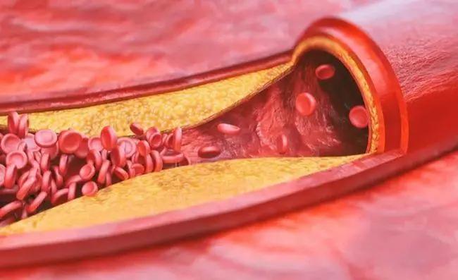 发现动脉硬化还能活多久,发现血管斑块是不是就是脑梗了