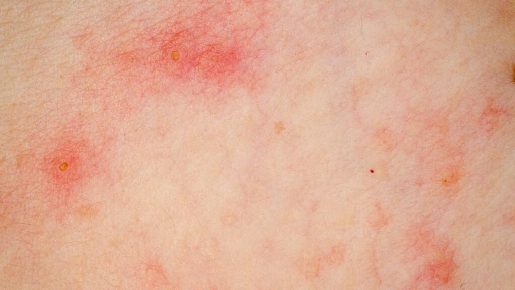 hpv感染有什么症状长湿疹,湿疹和hpv感染起的疹子一样吗