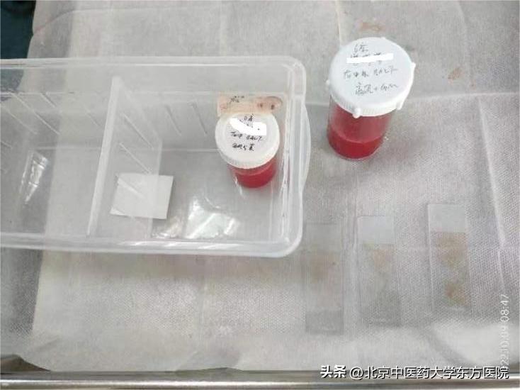 咳嗽痰中带血不可小视可能隐藏着大疾患