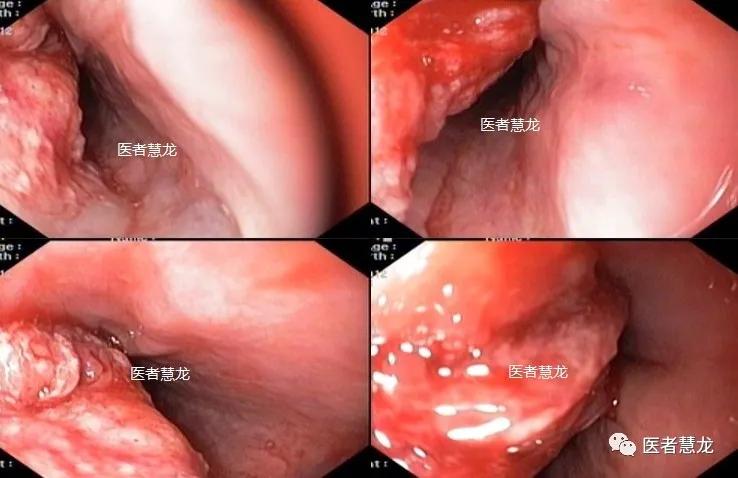 光动力疗法治愈进展期食管癌一例带来的思考和启示