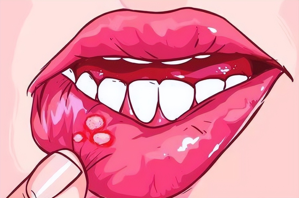 口腔溃疡吃维生素b1b2b12维生素c,有种痛叫口腔溃疡