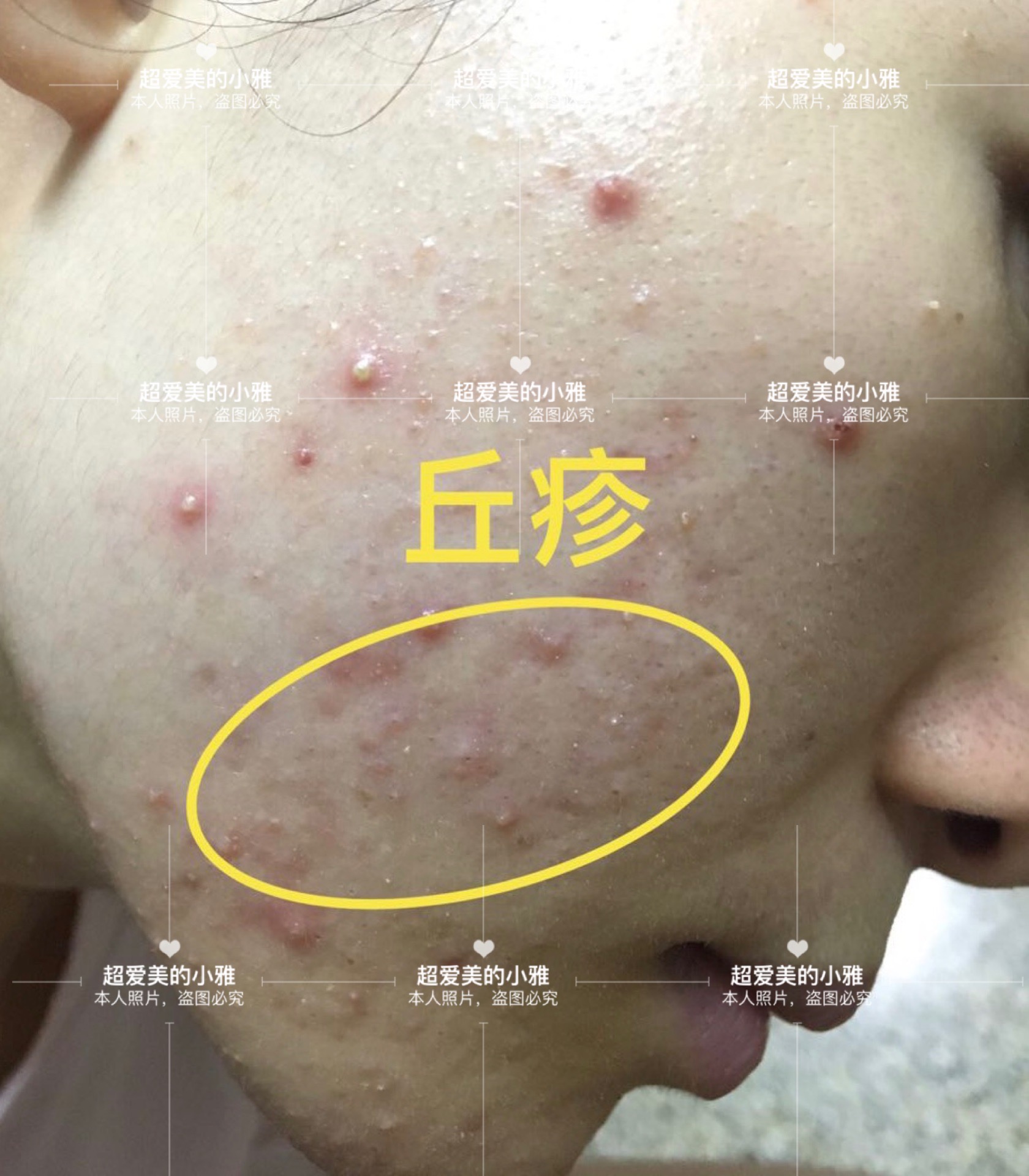 痘痘严重爆发如何战痘到底,痘痘的常见问题解决方法在这里