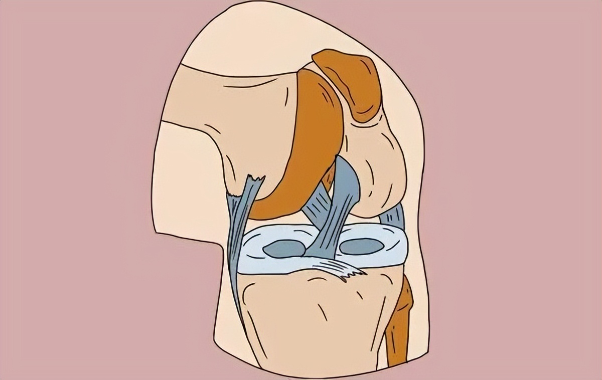 半月板保护用护膝还是髌骨带,半月板是消耗品吗