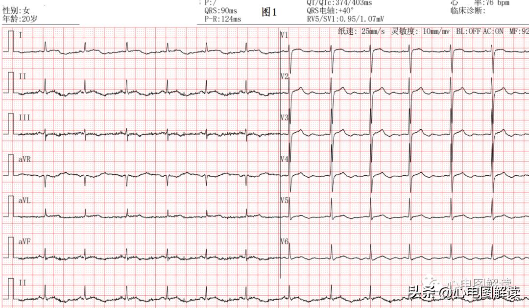心电图会误诊冠心病吗,心电图会误诊心肌梗死吗
