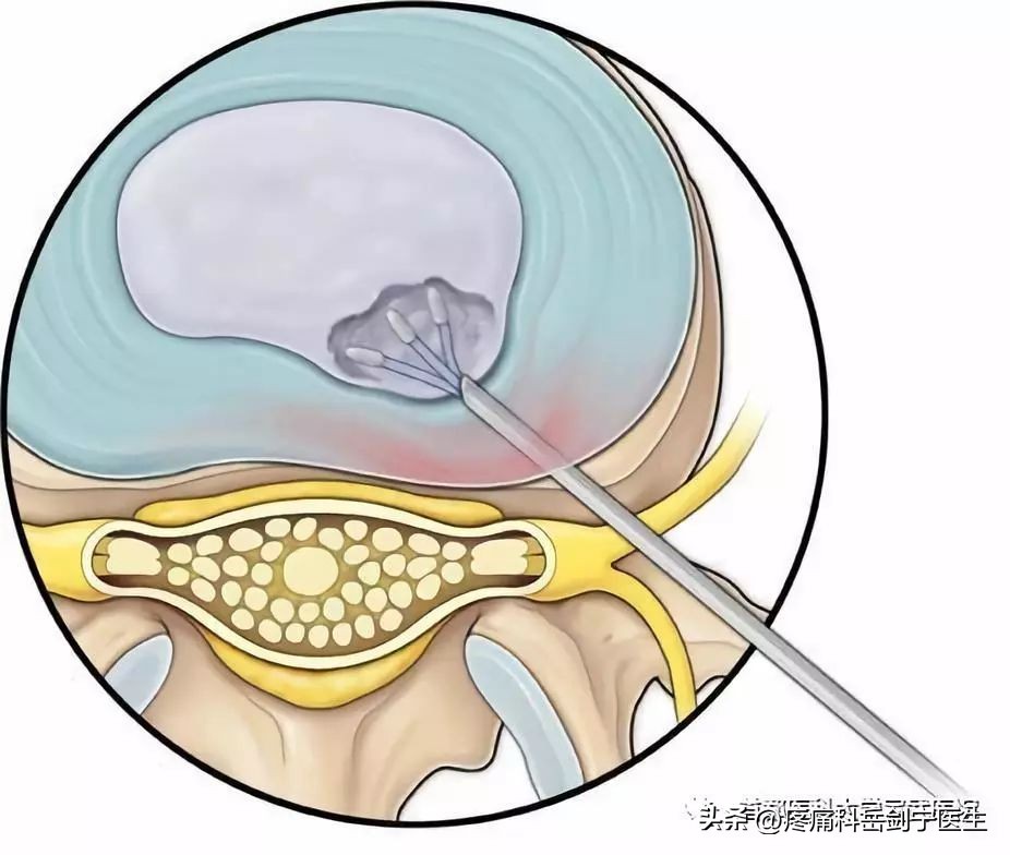 椎间盘突出微创介入疗法图片,椎间盘射频靶点消融术图解