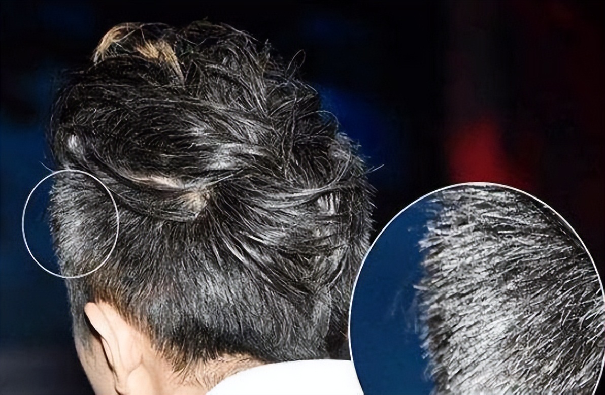 前额和鬓角白发是什么原因,两鬓和后脑勺长白发是什么原因