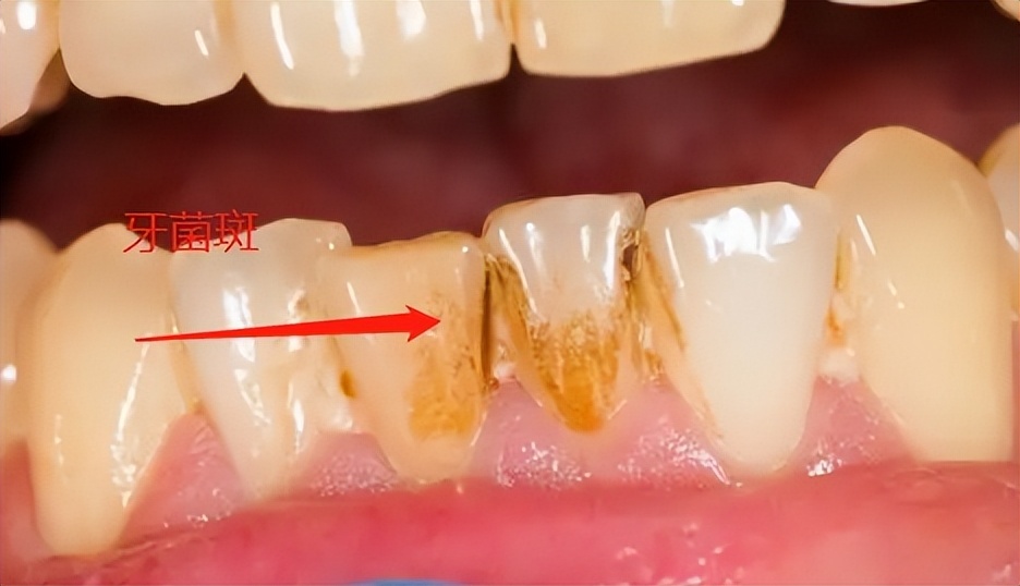蛀牙如何防止牙齿继续蛀下去,蛀牙治疗后注意事项及饮食