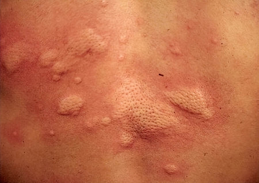 疫情期间皮肤病增多,不幸染上皮肤病怎么办