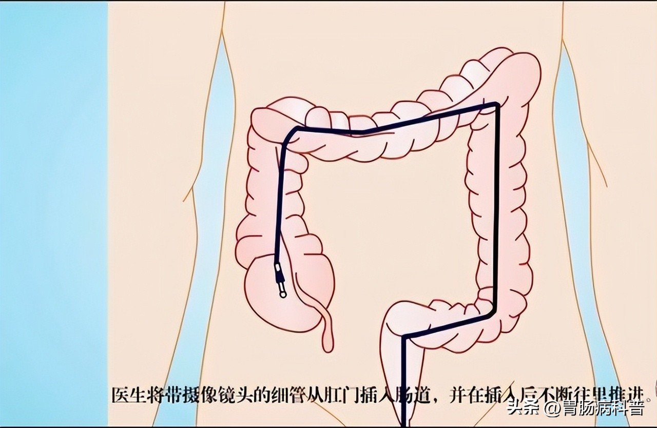 做肠镜检查前怎样清肠最彻底,肠镜检查前清肠的药怎么喝