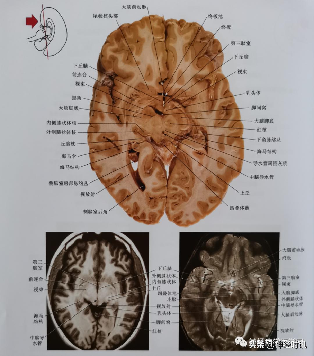 ct袖珍断层解剖图谱最新版,头颅ct断层解剖图谱无水印