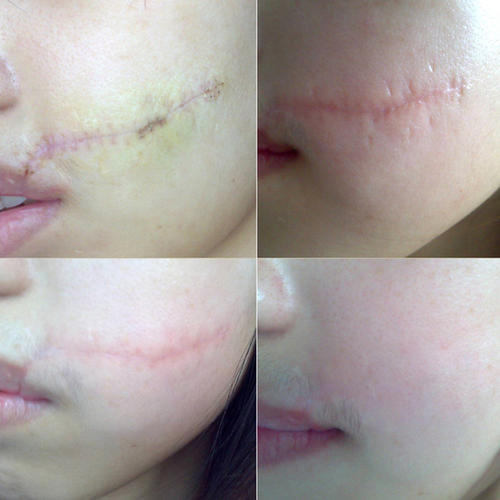 像个“小肉球”似的增生疤痕，是不是无药可救了？医生这样说：