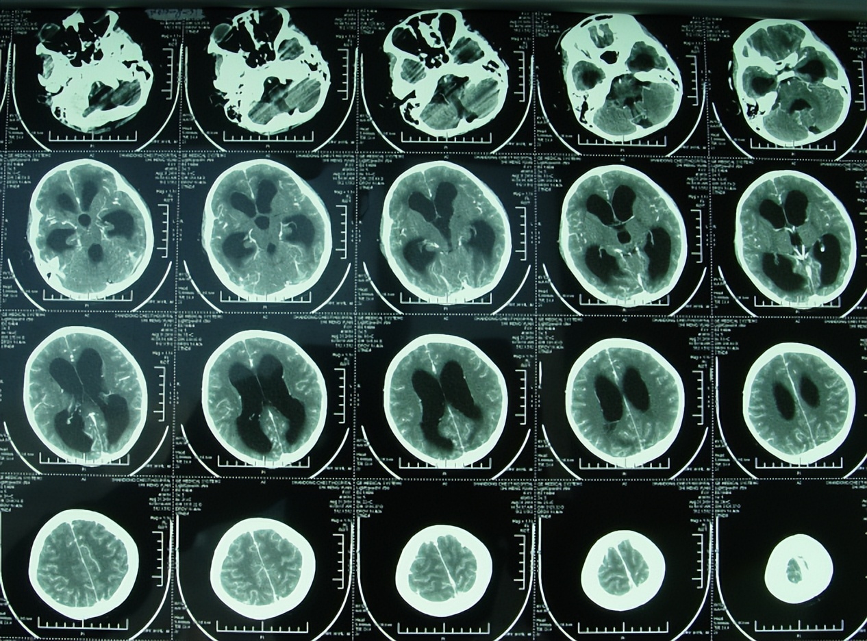 儿童结核脑膜炎脑积水,结核性脑膜炎脑积水如何引起