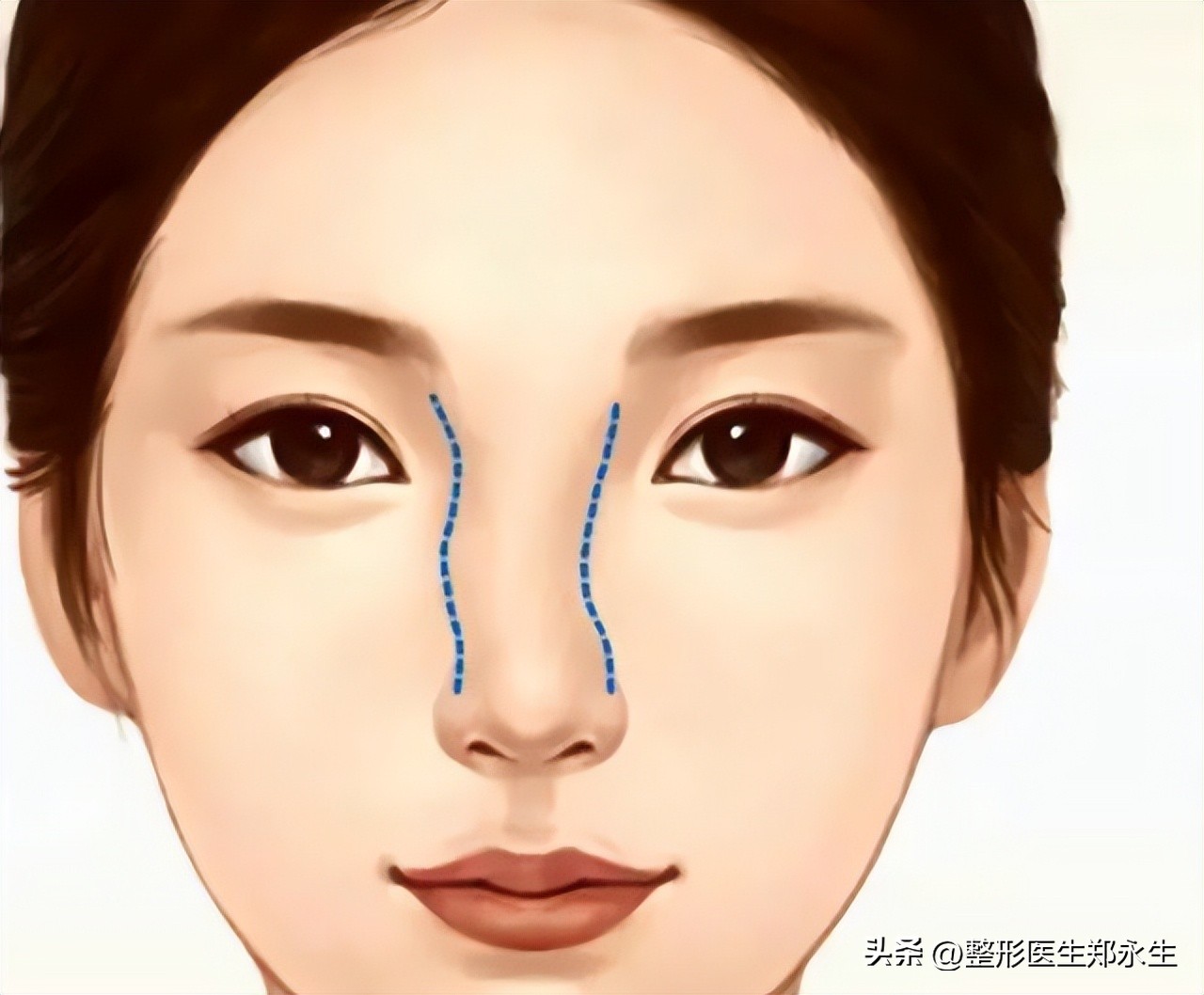 鼻子歪了怎么矫正,鼻子歪了矫正后呼吸会好吗