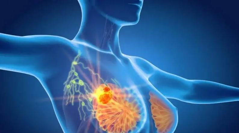 注意这8种女性容易被乳腺癌缠上,长期穿内衣对乳腺有损伤吗