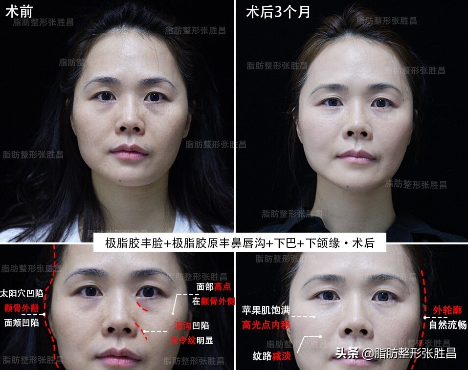 菱形脸颧骨突出怎么改善,颧骨高太阳穴凹陷全脸填充的效果