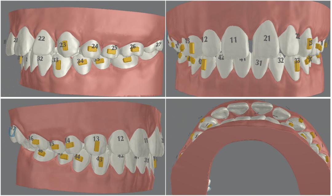 无托槽隐形矫治流程,隐形矫正早期干预