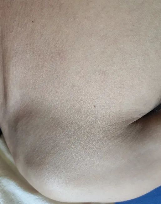 带状疱疹后遗神经痛针灸治疗方法,舒卿针灸治疗带状疱疹后遗神经痛