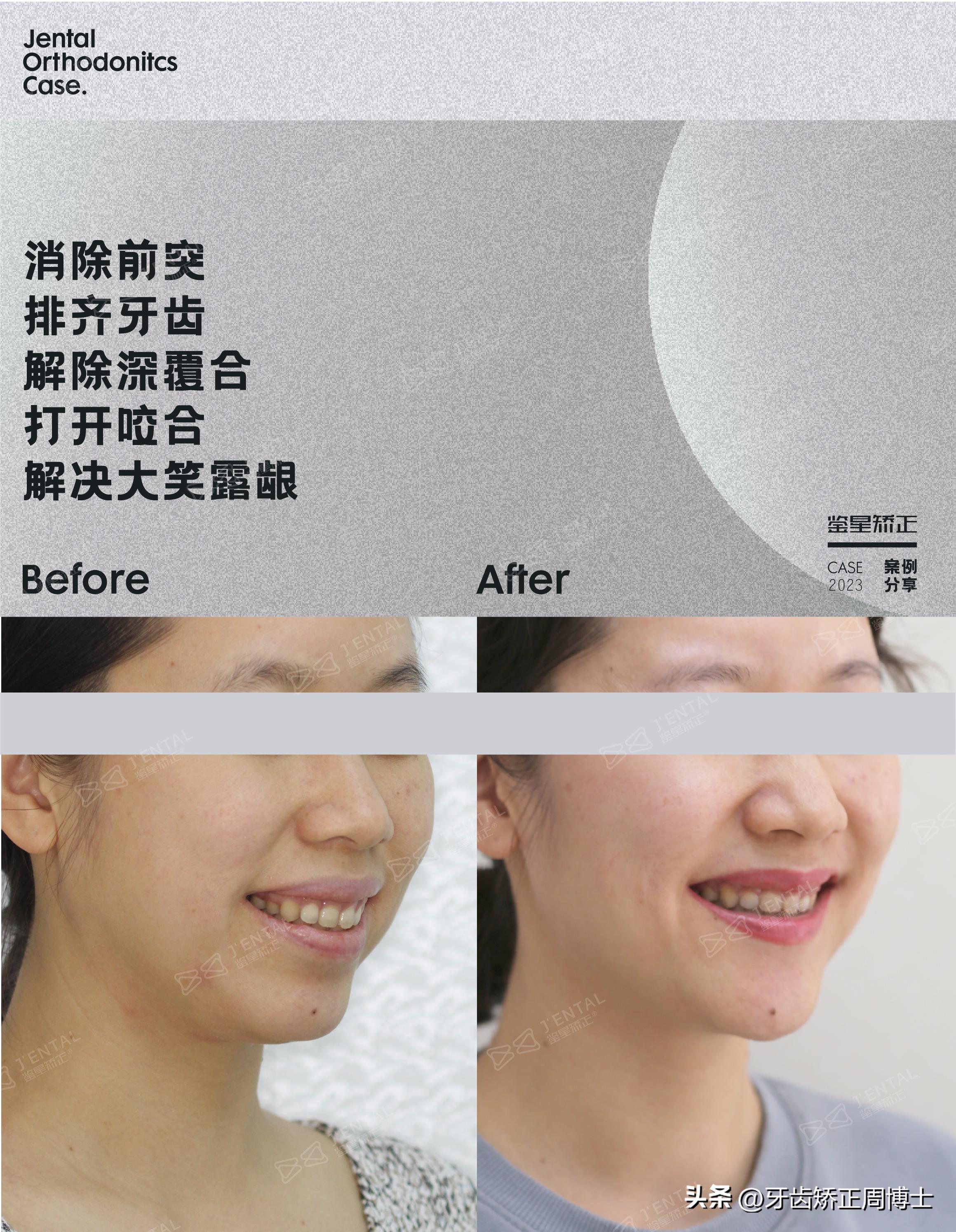 骨性龅牙怎么通过普通的矫正改善,骨钉如何解决骨性龅牙