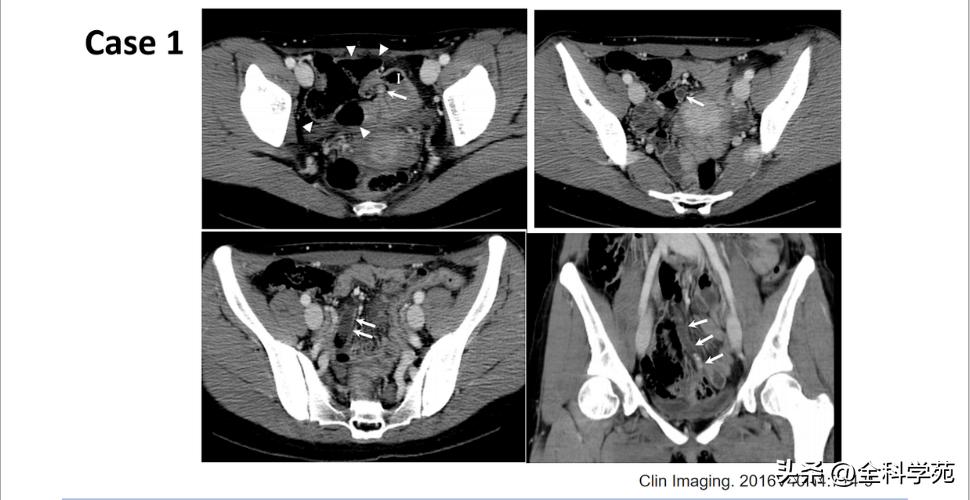阑尾炎的讲解,关于阑尾炎的讨论总结