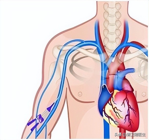 化疗常用输液方式：留置针、PICC和输液港的注意事项