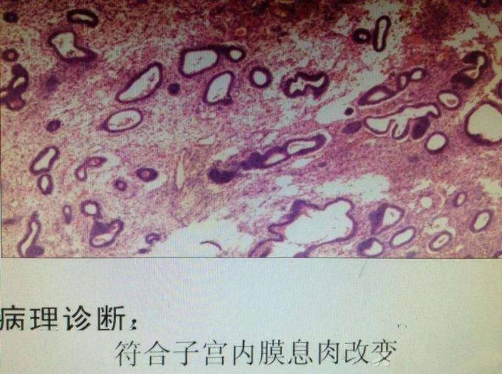 出血不止有血块是什么原因,排卵期出血跟子宫内膜息肉有关吗