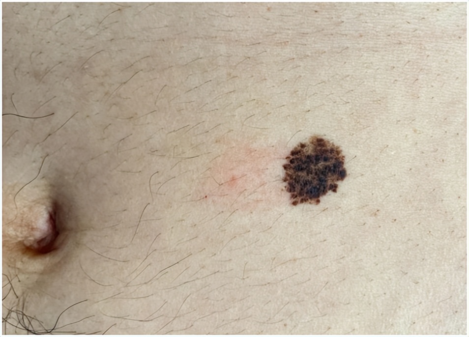 谈痣色变,身上长的痣都是色素痣吗