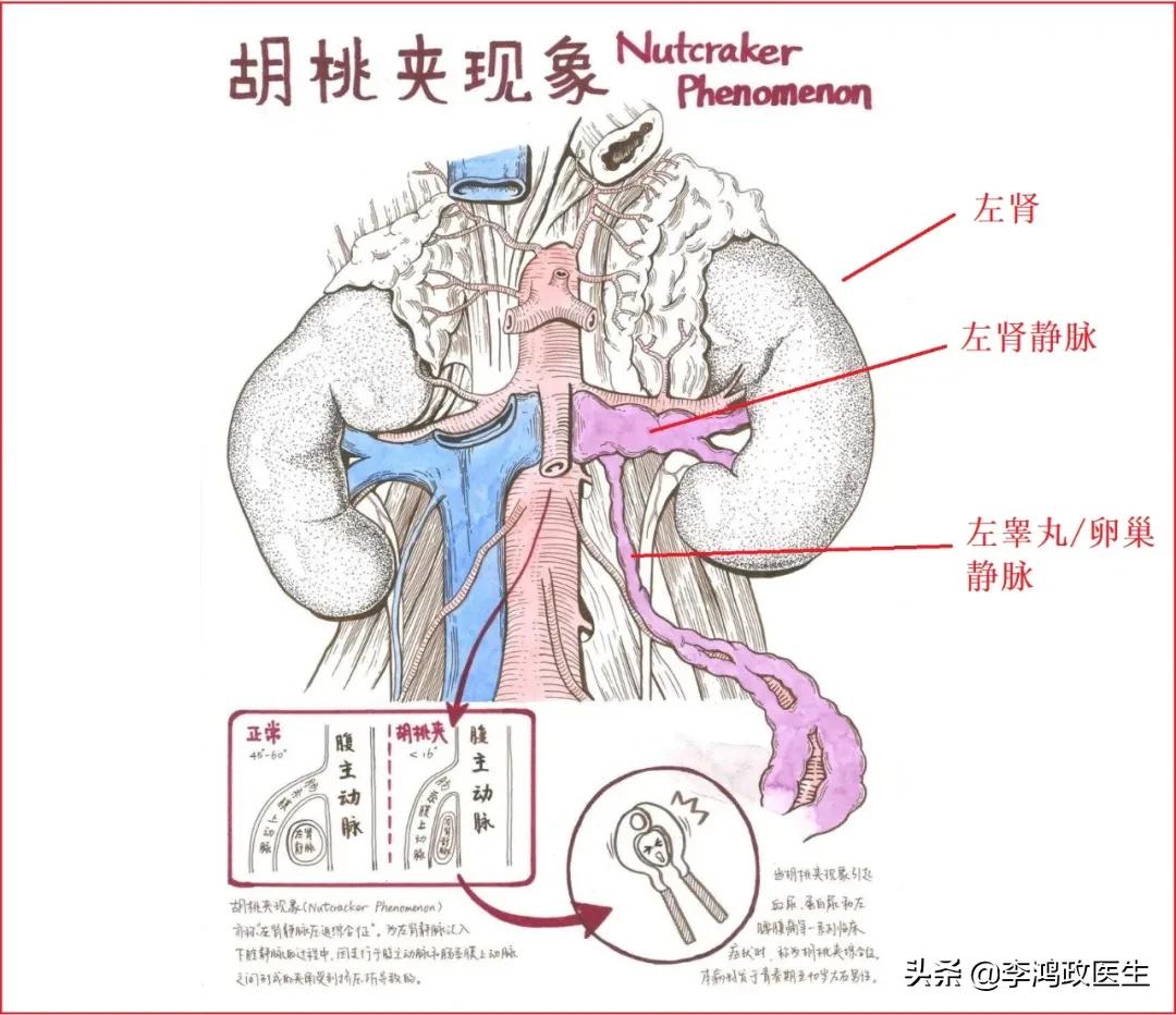 腰间盘突出有没有可能误诊,女子腰痛误诊腰椎间盘突出
