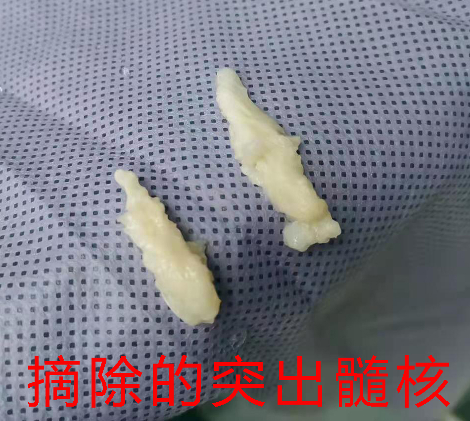 深圳正康骨科治腰椎间盘突出费用,深圳正康骨科医院预约手术信息