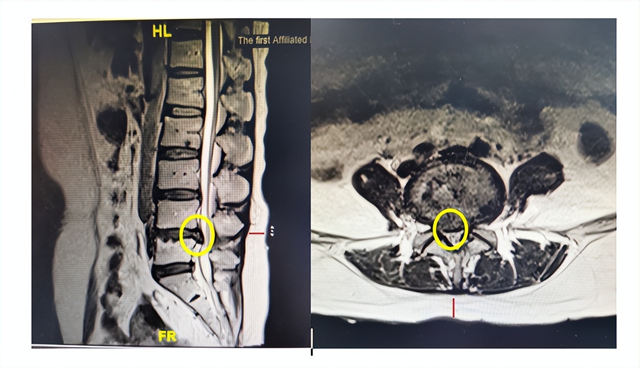 腰椎间盘突出微创姑息法,38岁腰椎间盘突出微创
