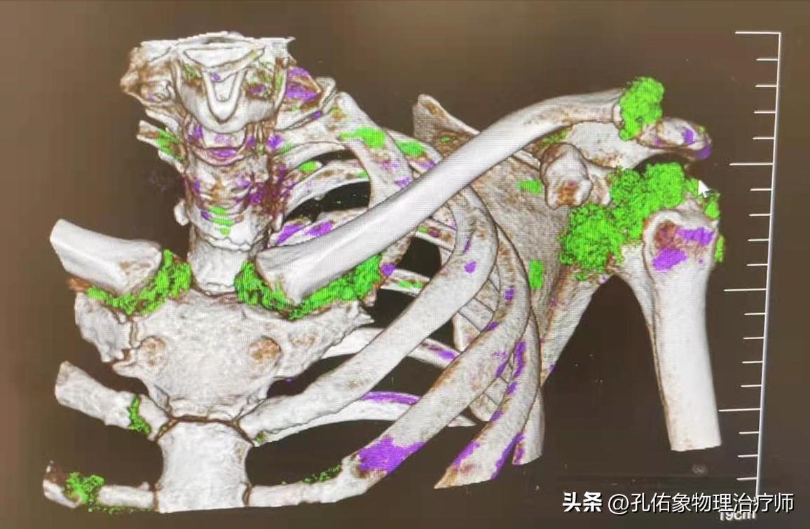 痛风患者哪些豆类不能吃,我国超千万人患痛风祸根