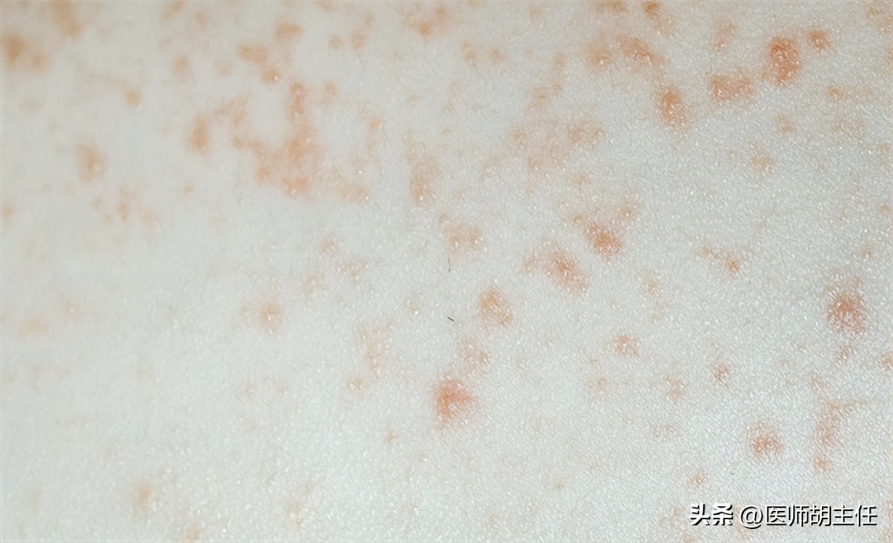 别把艾滋病当皮肤病治,不要错把艾滋病当皮肤病