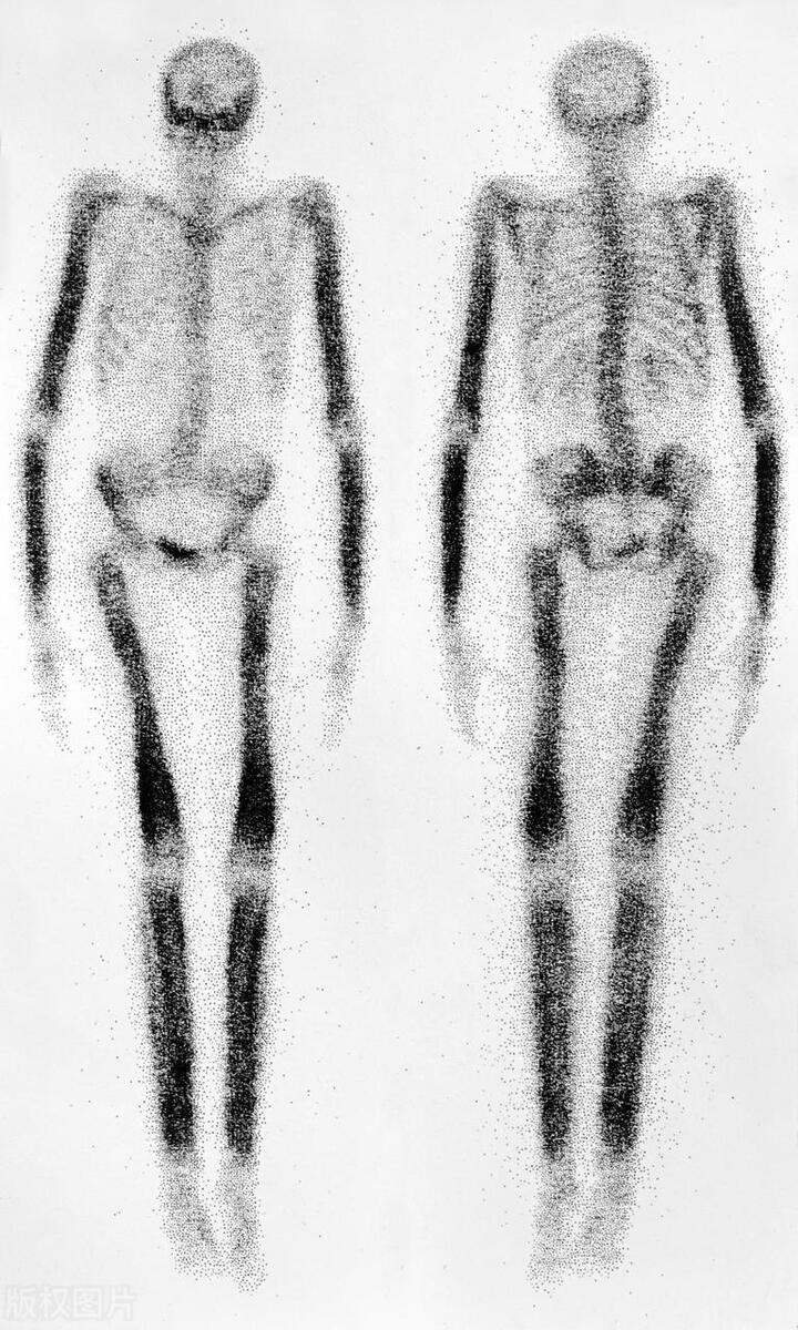 前列腺癌晚期骨转移怎么治,前列腺癌晚期骨转移首选治疗方法