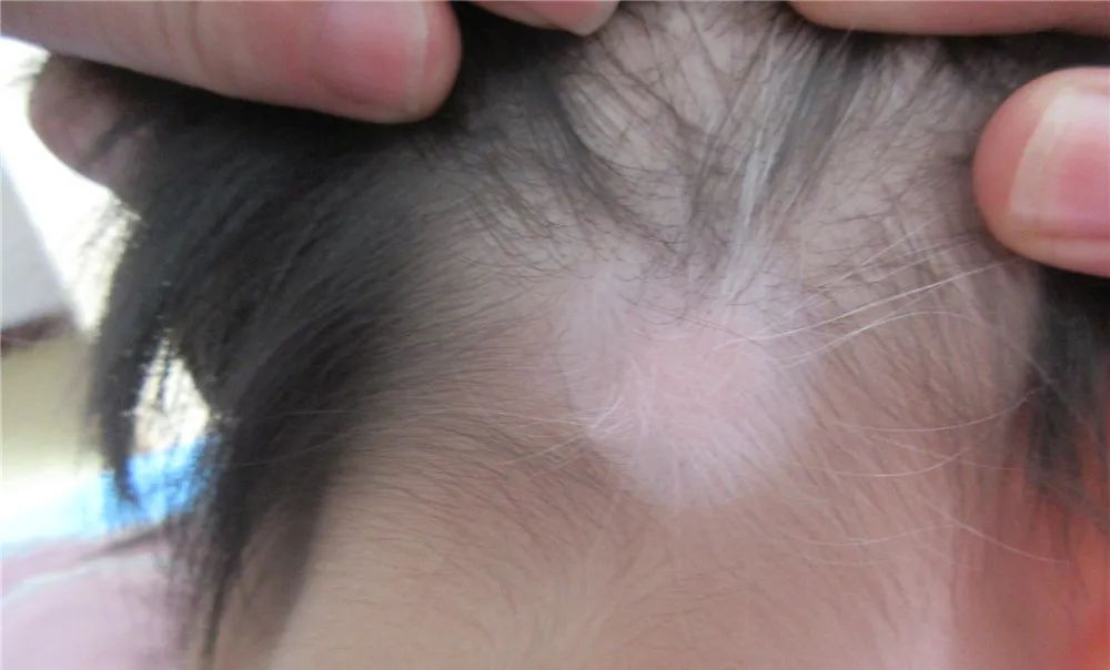 头部白癜风白发能治愈吗,头部白癜风治疗后反而扩散